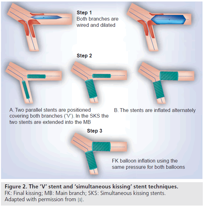 interventional-cardiology-stent-techniques