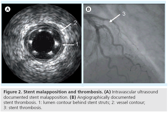 interventional-cardiology-stent-thrombosis