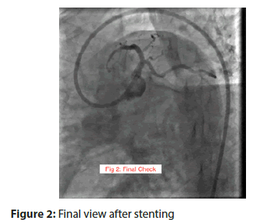 interventional-cardiology-stenting