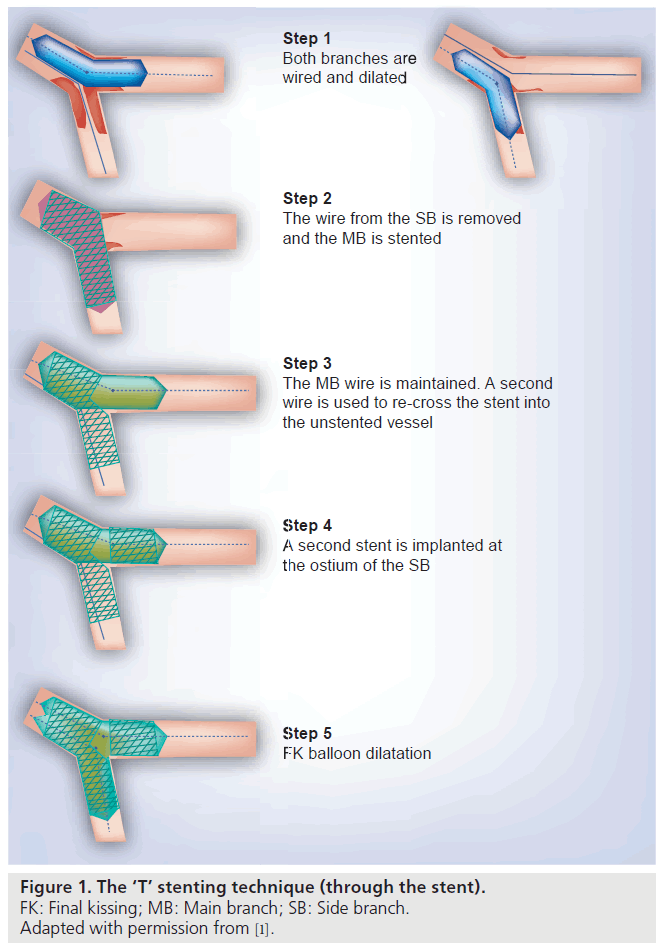 interventional-cardiology-stenting-technique