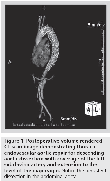 interventional-cardiology-subclavian-artery-extension