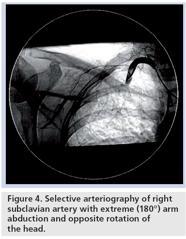 interventional-cardiology-subclavian-artery-extreme
