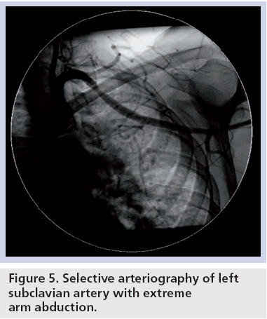 interventional-cardiology-subclavian-artery-extreme