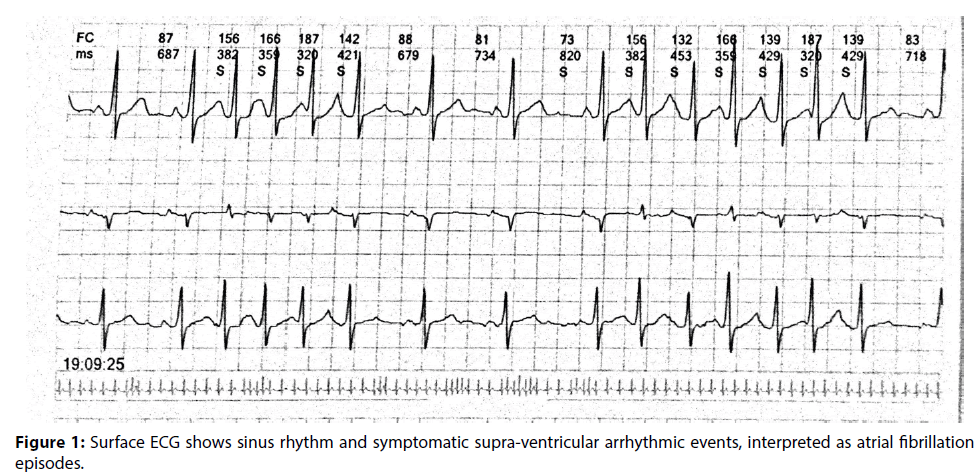 interventional-cardiology-supra-ventricular