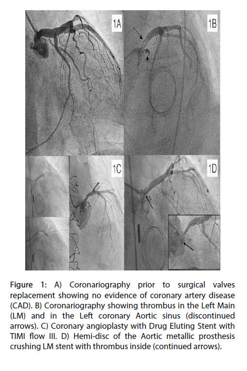 interventional-cardiology-surgical-valves