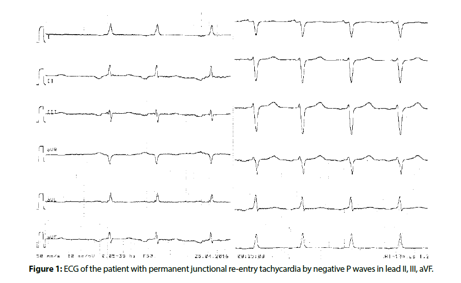 interventional-cardiology-tachycardia-negative-P-waves