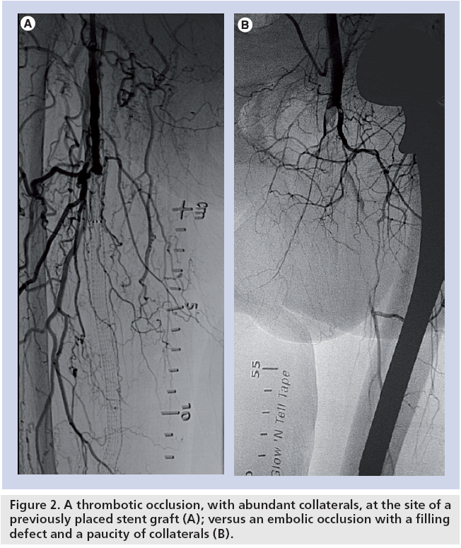 interventional-cardiology-thrombotic-occlusion