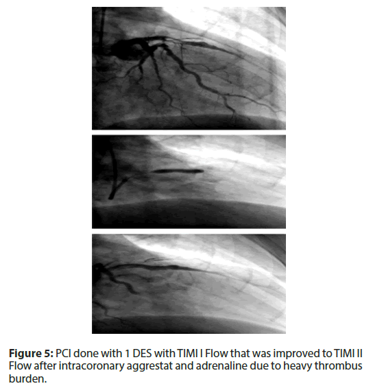 interventional-cardiology-thrombus