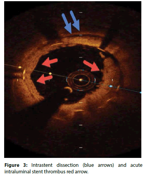 interventional-cardiology-thrombus-red