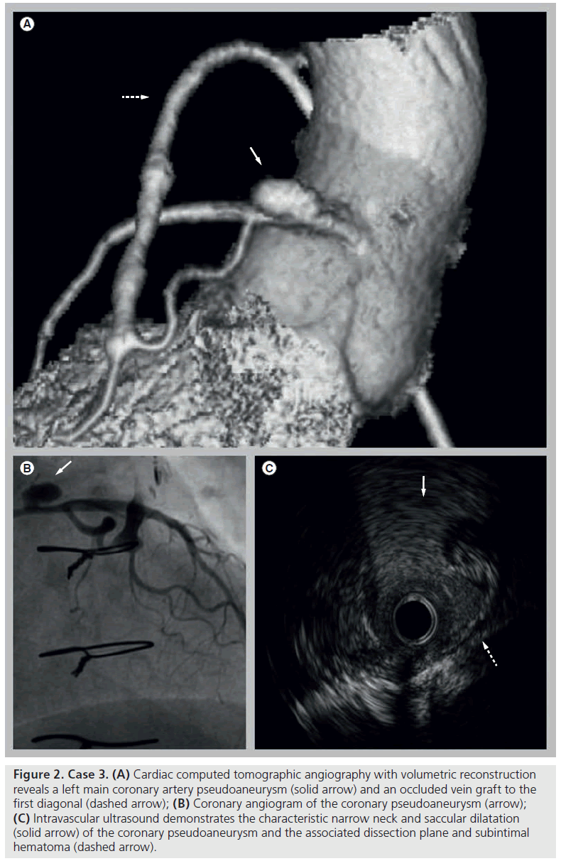 interventional-cardiology-tomographic