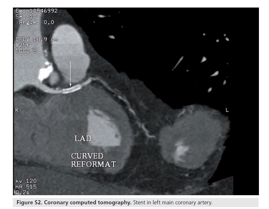 interventional-cardiology-tomography