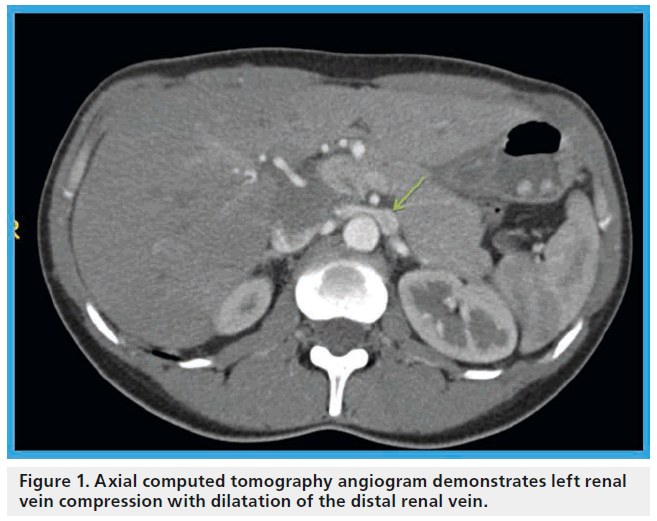 Current Management Approach For Left Renal Vein Entrapment Syndrome The So Called A A A Nutcrackera A A Syndrome