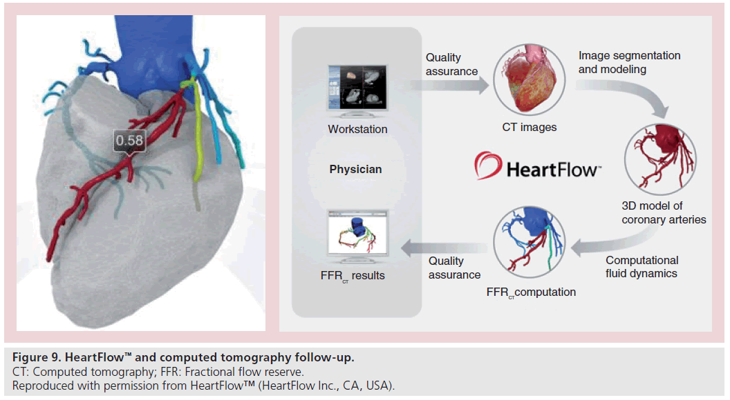 interventional-cardiology-tomography