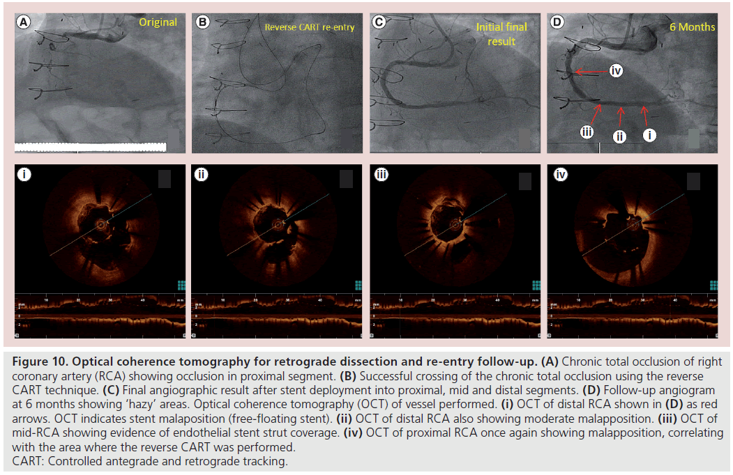 interventional-cardiology-tomography