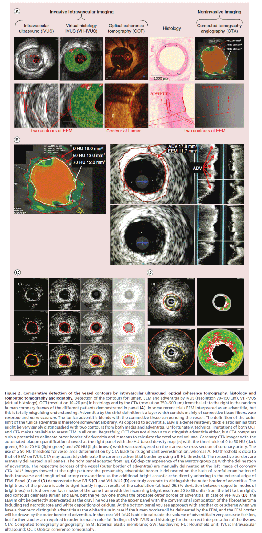 interventional-cardiology-tomography-angiography