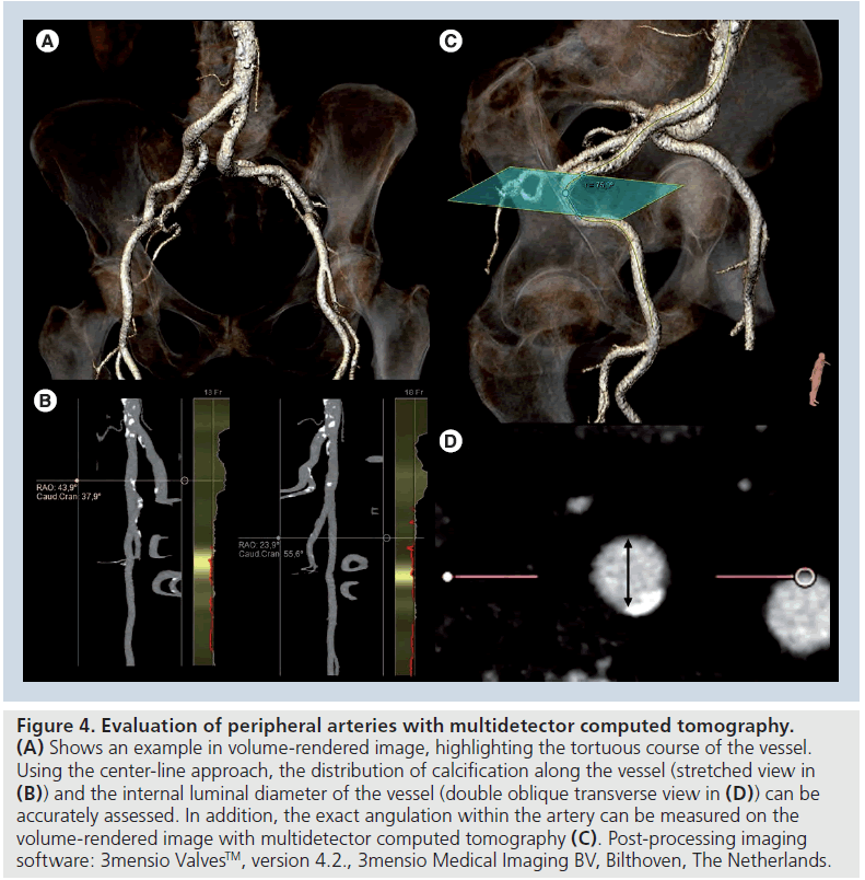 interventional-cardiology-tortuous