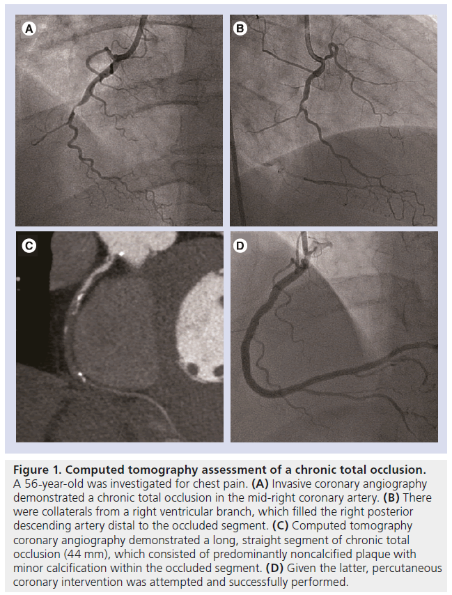 interventional-cardiology-total-occlusion