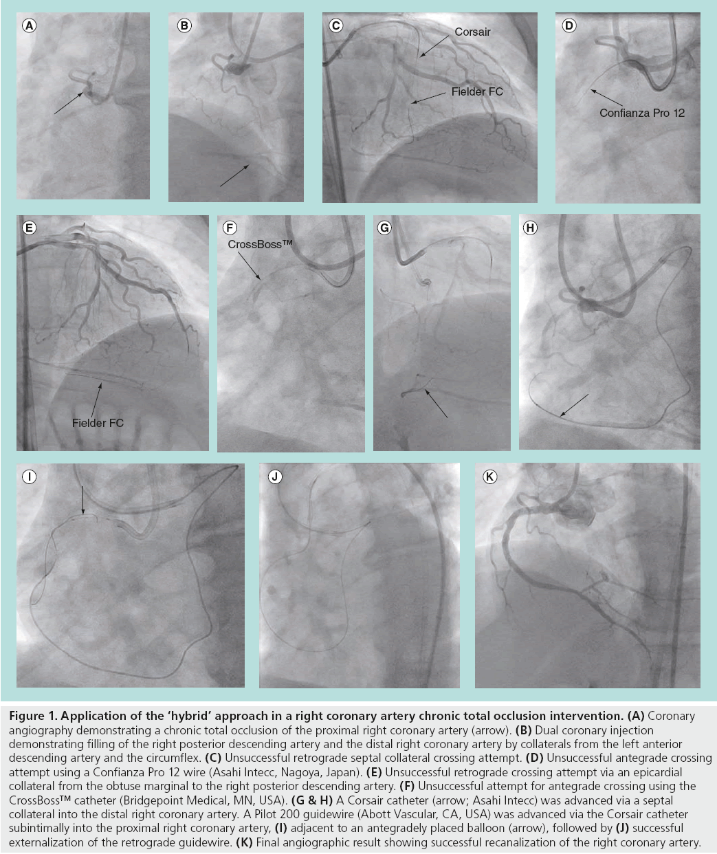 interventional-cardiology-total-occlusion-intervention