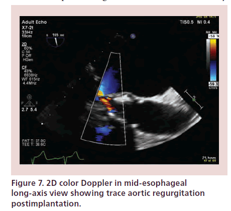 interventional-cardiology-trace-aortic