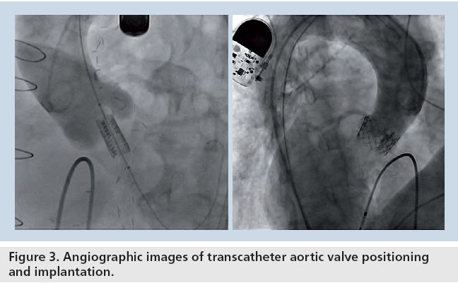 interventional-cardiology-transcatheter-aortic-valve