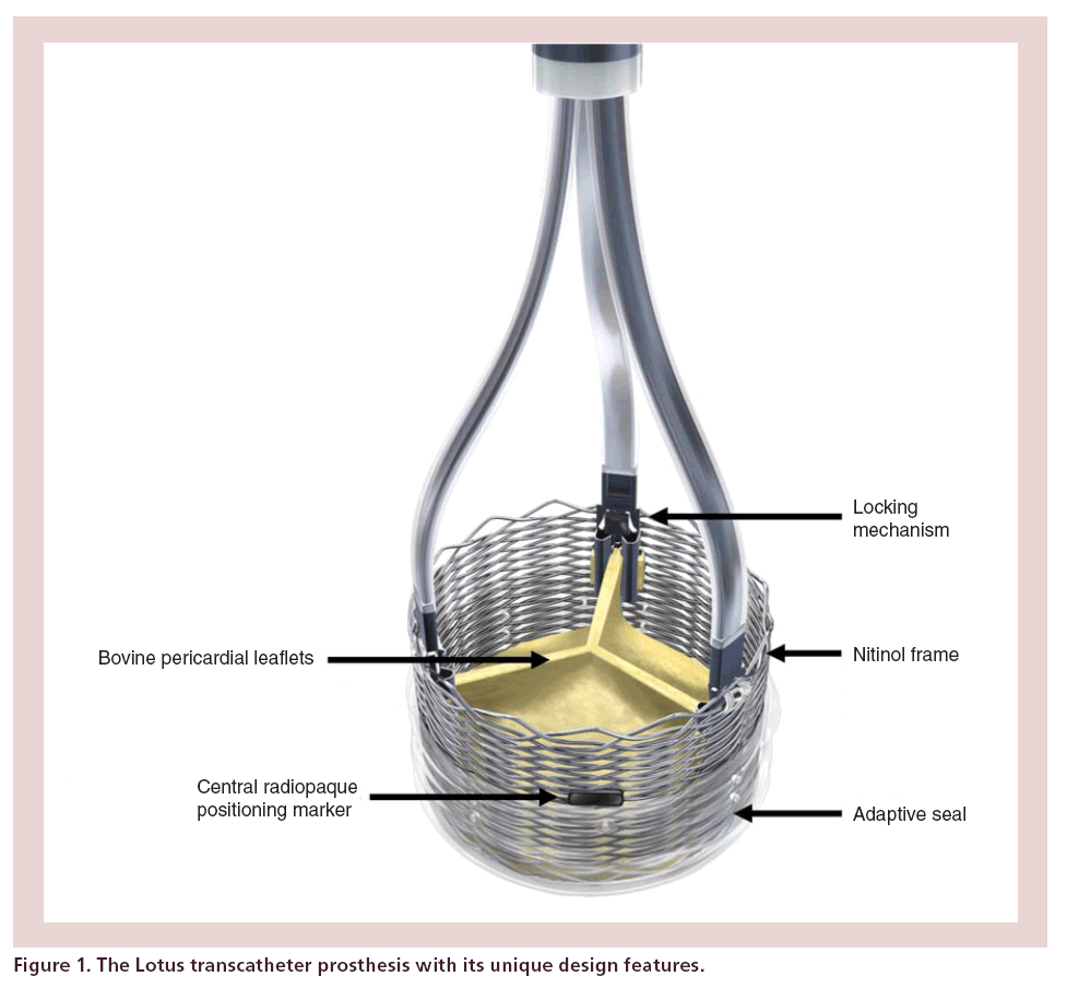 interventional-cardiology-transcatheter-prosthesis