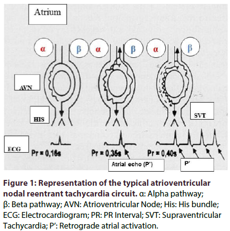 interventional-cardiology-typical-atrioventricular