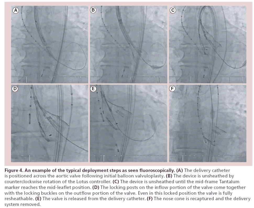interventional-cardiology-typical-deployment