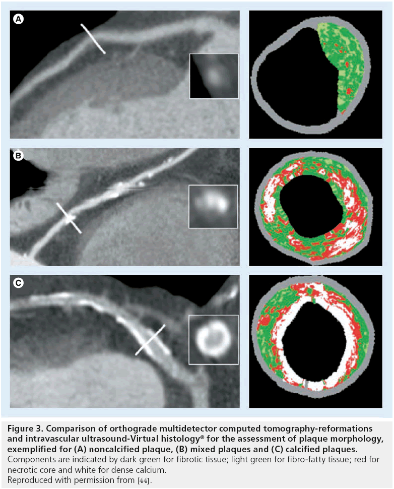 interventional-cardiology-ultrasound-Virtual-histology