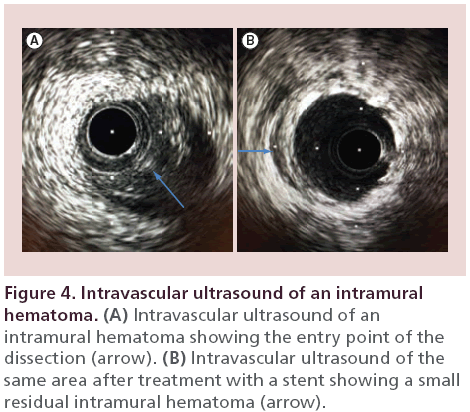 interventional-cardiology-ultrasound-intramural