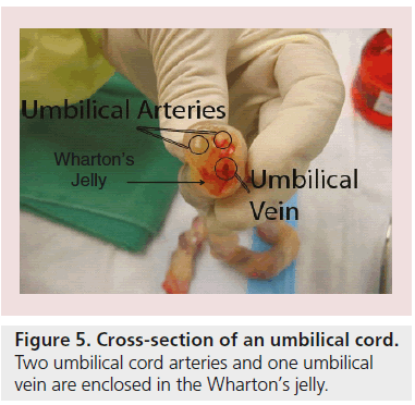 interventional-cardiology-umbilical-cord