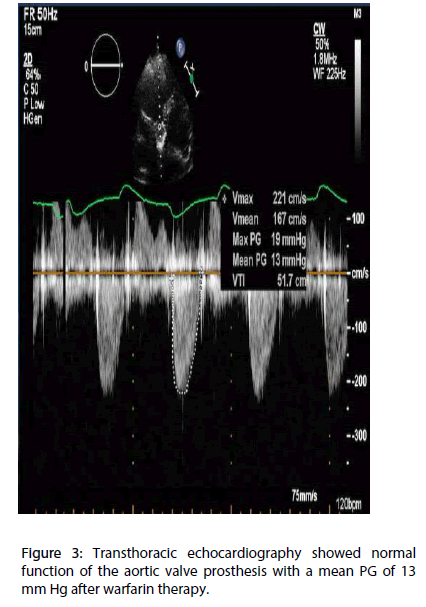 interventional-cardiology-valve-prosthesis