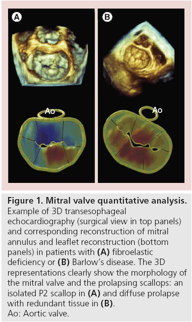 interventional-cardiology-valve-quantitative-analysis