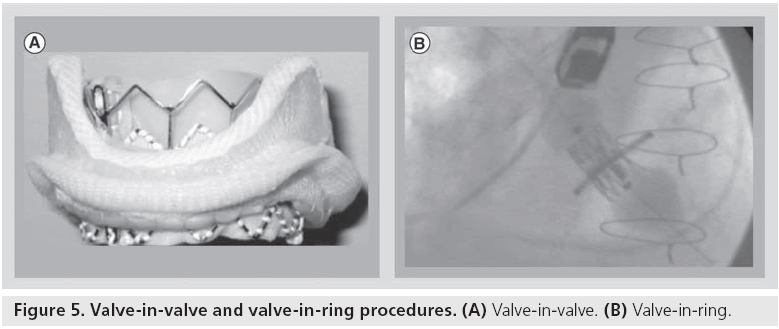 interventional-cardiology-valve-ring-procedures