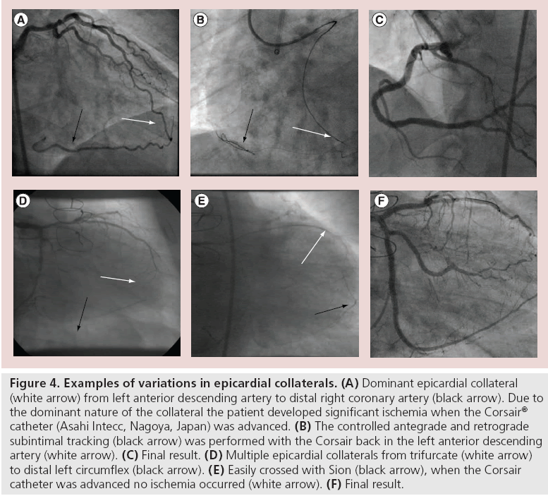interventional-cardiology-variations-epicardial-collaterals