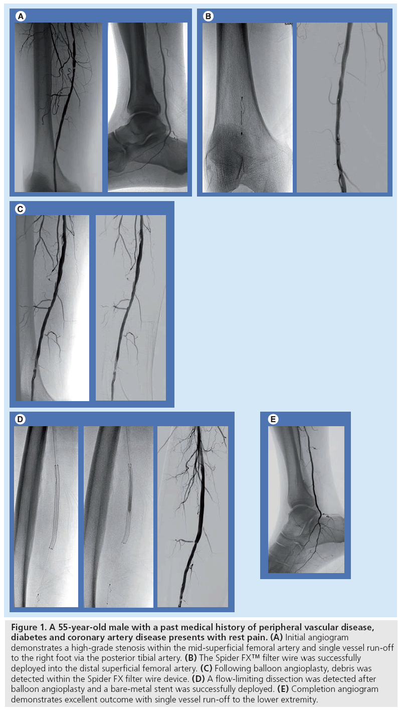 interventional-cardiology-vascular-disease