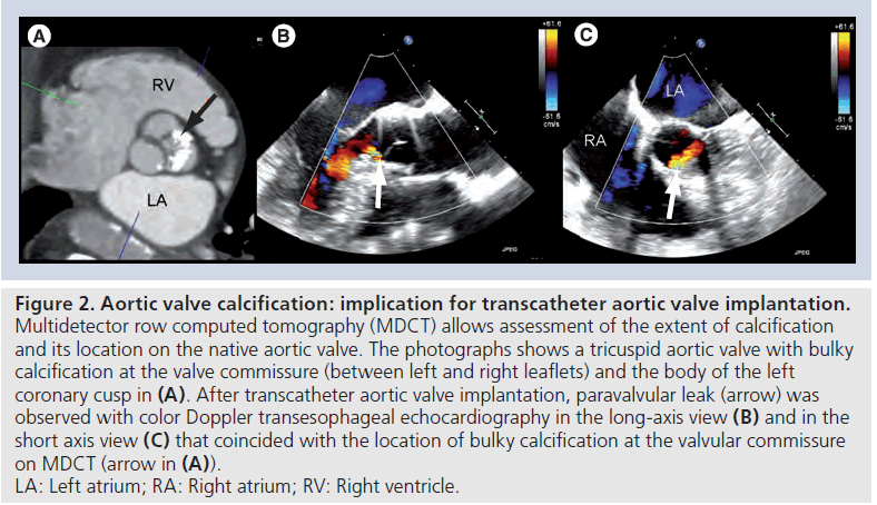 interventional-cardiology-ventricle