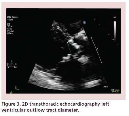 interventional-cardiology-ventricular-outflow