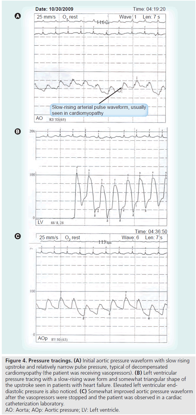 interventional-cardiology-waveform