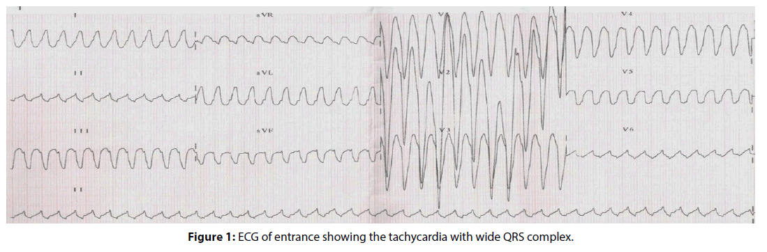 interventional-cardiology-wide-QRS-complex