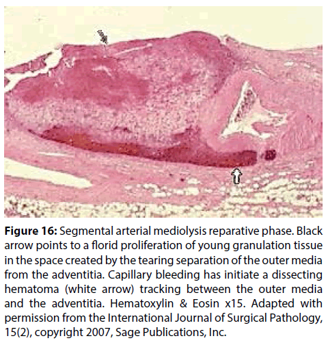 interventional-cardiology-young-granulation