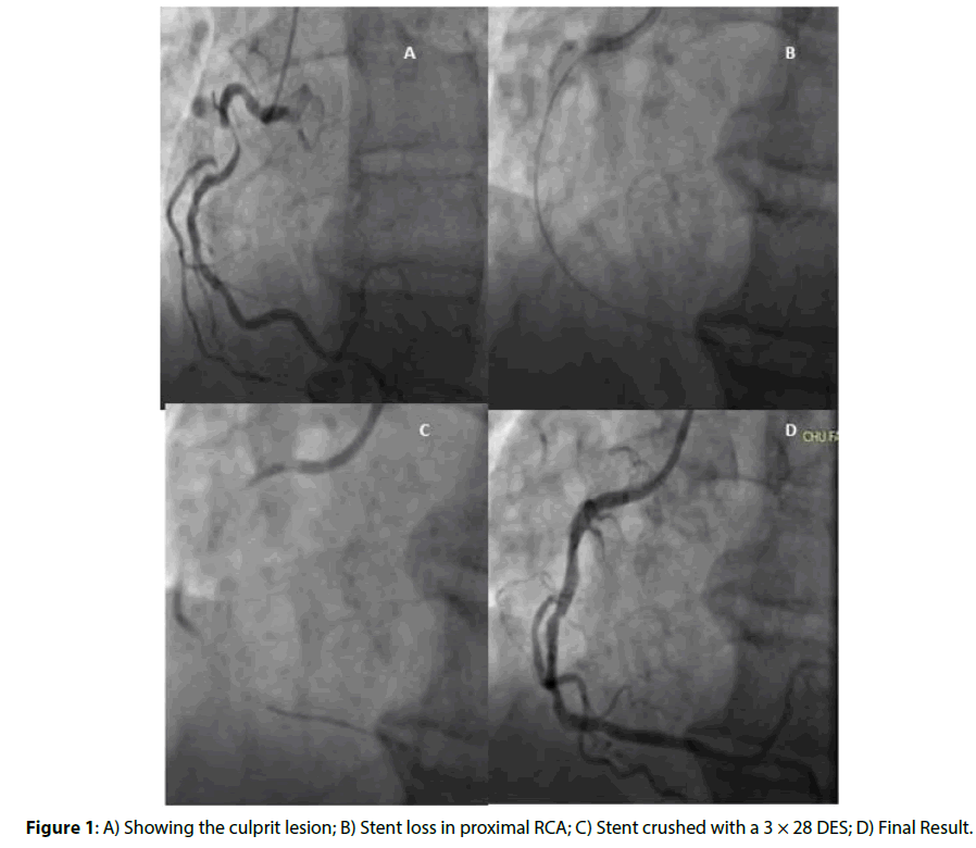 interventional-culprit-lesion