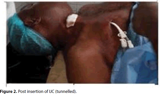 interventional-nephrology-Post-insertion