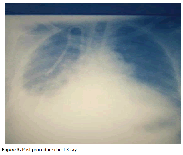 interventional-nephrology-Post-procedure