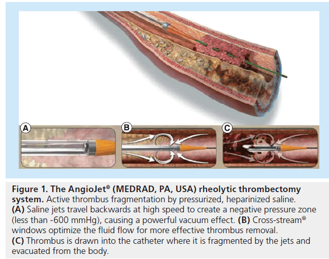 interventional-rheolytic-saline