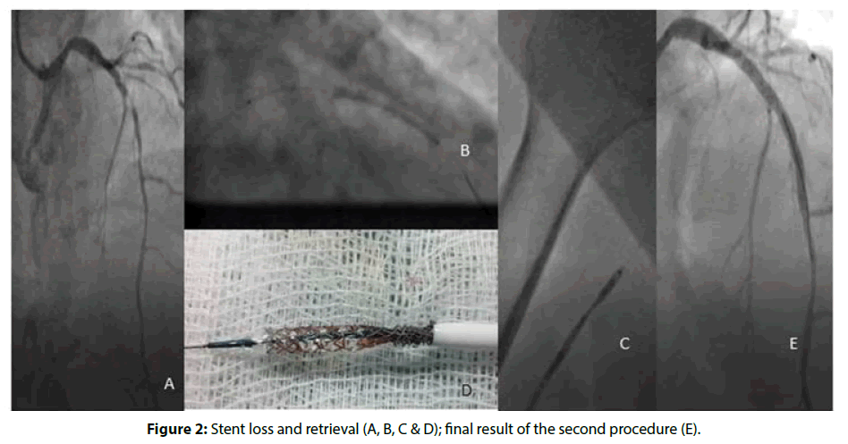 interventional-second-procedure